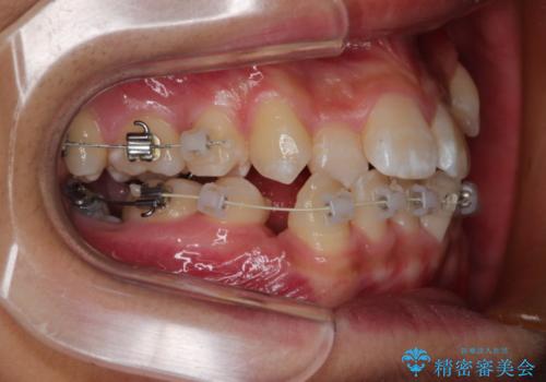 前歯のガタガタを改善　八重歯も無くなりキレイな歯並びにの治療中