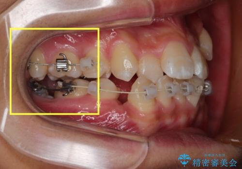 全顎矯正治療の部分的な紹介 ～横向きに生えた奥歯を整直させる～の治療中