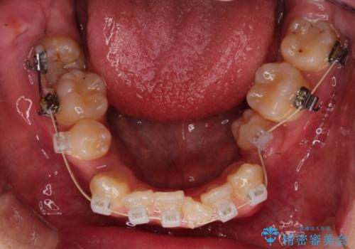 前歯のガタガタを改善　八重歯も無くなりキレイな歯並びにの治療中