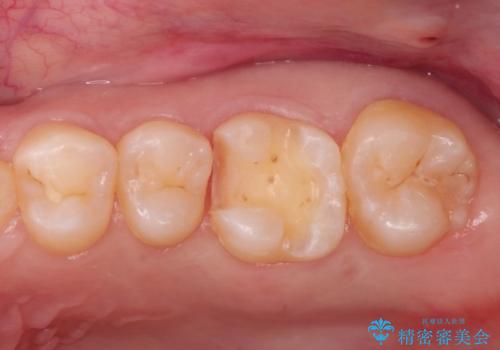 虫歯の再発　セラミックインレー修復の治療中