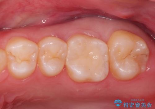 虫歯の再発　セラミックインレー修復の治療後