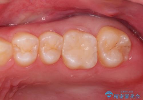 虫歯の再発　セラミックインレー修復