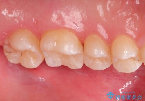 虫歯の再発　セラミックインレー修復の治療後