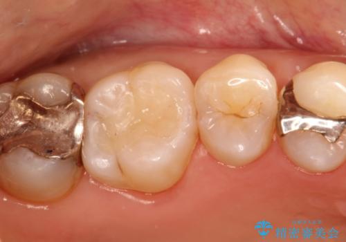 セラミックインレー 天然の歯に近い透明感や色調を再現するの治療後