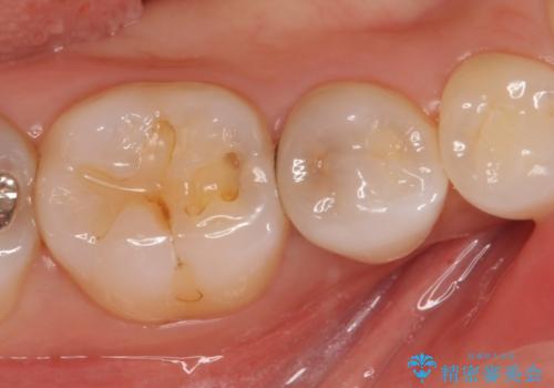 セラミックインレー　PGA(ゴールド)インレー　虫歯治療の治療前
