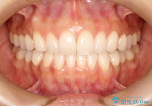 前歯の出っ歯とでこぼこをインビザラインで改善の治療後