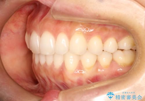 前歯の出っ歯とでこぼこをインビザラインで改善の治療後