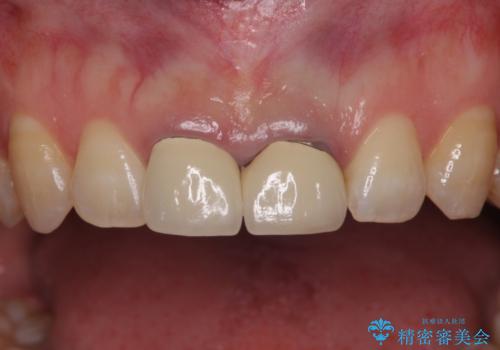短い前歯を長くしたい　外科処置を用いた前歯のセラミック治療の治療前