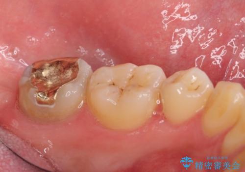 小さい虫歯　歯にやさしいゴールドインレーの治療前