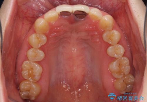 短い前歯を長くしたい　外科処置を用いた前歯のセラミック治療の治療前