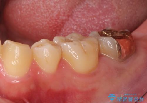 小さい虫歯　歯にやさしいゴールドインレーの治療前