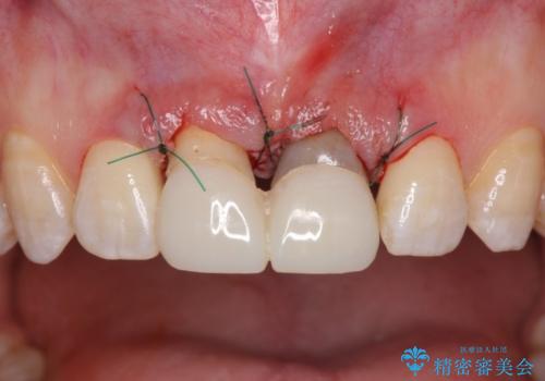 短い前歯を長くしたい　外科処置を用いた前歯のセラミック治療の治療中
