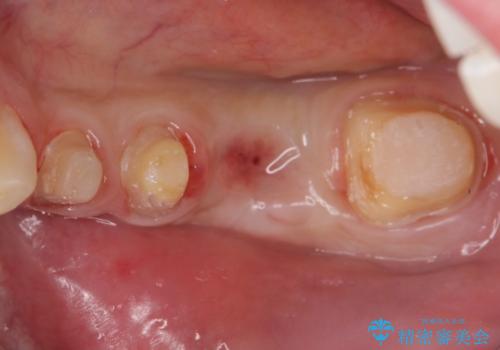 オールセラミッククラウン　歯冠長延長術　歯の高さが低い歯の治療の治療中
