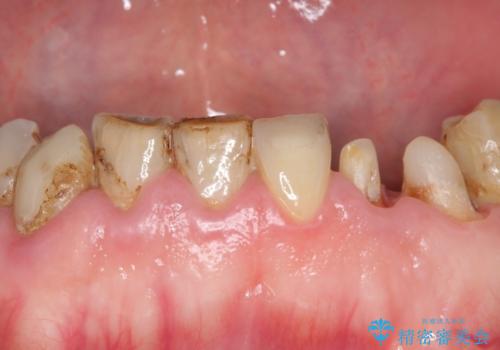 前歯2本のオールセラミッククラウン　根管治療後の補綴の治療中