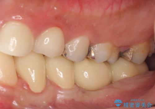 オールセラミッククラウン　歯冠長延長術　歯の高さが低い歯の治療の治療後