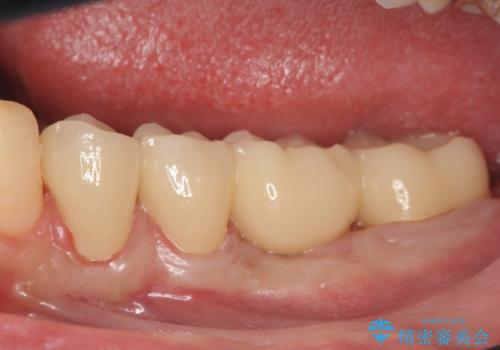 オールセラミッククラウン　歯冠長延長術　歯の高さが低い歯の治療の治療後
