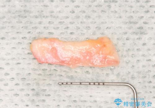 矯正治療後の歯肉退縮　歯肉移植による根面被覆の治療後