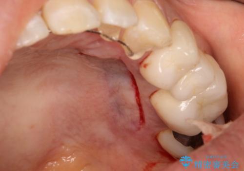 矯正治療後の歯肉退縮　歯肉移植による根面被覆の治療中