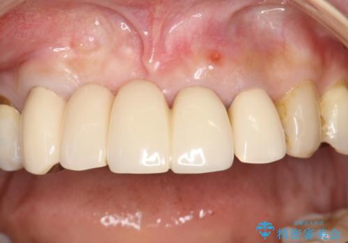 前歯のブリッジの再製作　根管治療からやり直すの治療前
