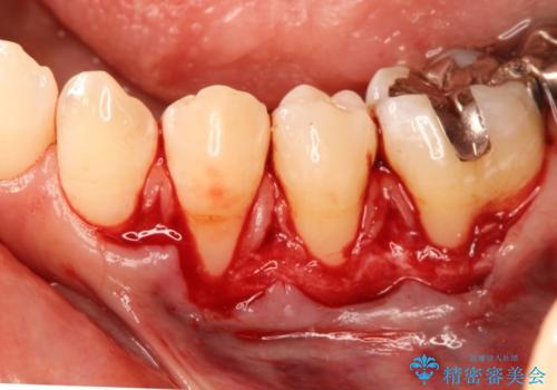 矯正治療後の歯肉退縮　歯肉移植による根面被覆の治療中