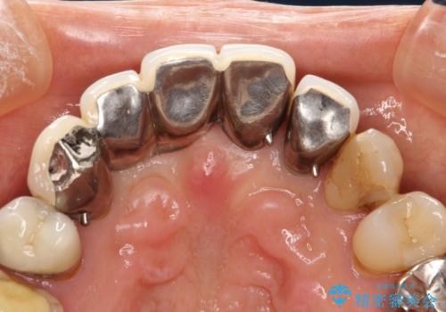 前歯のブリッジの再製作　根管治療からやり直すの治療前