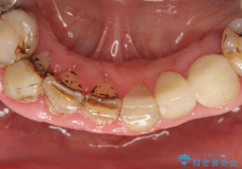前歯2本のオールセラミッククラウン　根管治療後の補綴の治療後