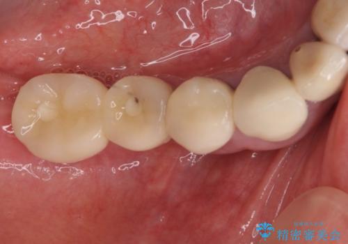 汚れがたまって気になる　歯ぐきとの境目から虫歯の治療前