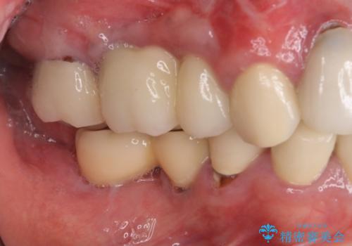 汚れがたまって気になる　歯ぐきとの境目から虫歯の治療前