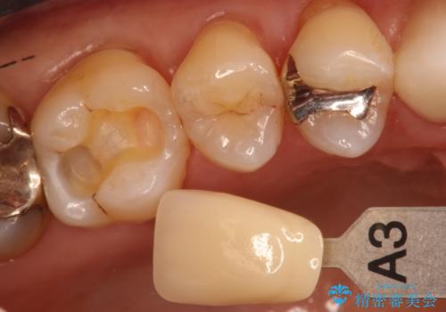 セラミックインレー 天然の歯に近い透明感や色調を再現するの治療中