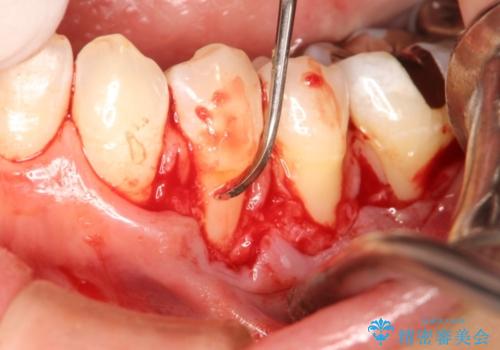 矯正治療後の歯肉退縮　歯肉移植による根面被覆の治療前