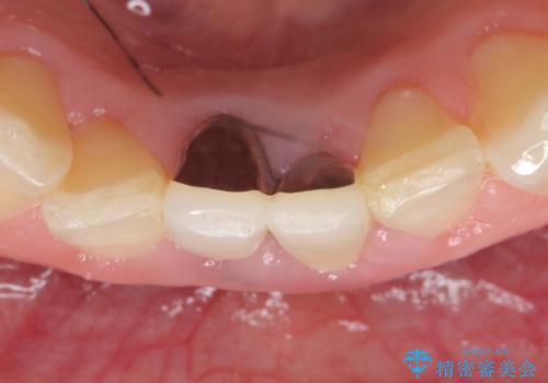 オールセラミッククラウン(エコノミー)　下顎前歯　根管治療後の補綴の治療前