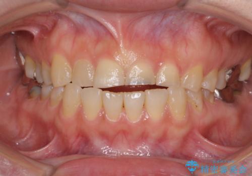 隙間の空いた前歯を治したい　部分矯正とオールセラミッククラウンの治療前