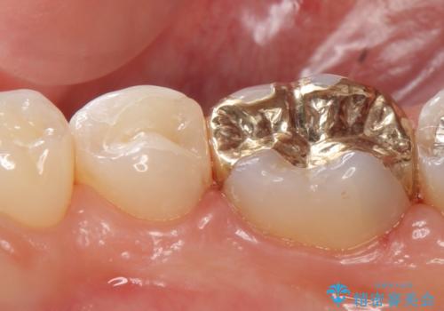 セラミックインレー　PGA(ゴールド)インレー　虫歯治療の治療後