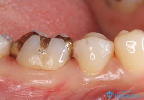 セラミックインレー　PGA(ゴールド)インレー　虫歯治療の治療後