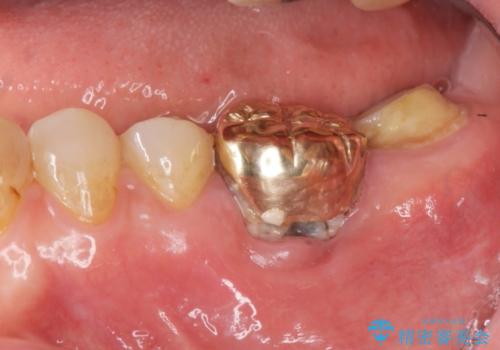 歯が割れた　ブリッジによる咬合機能回復の治療前