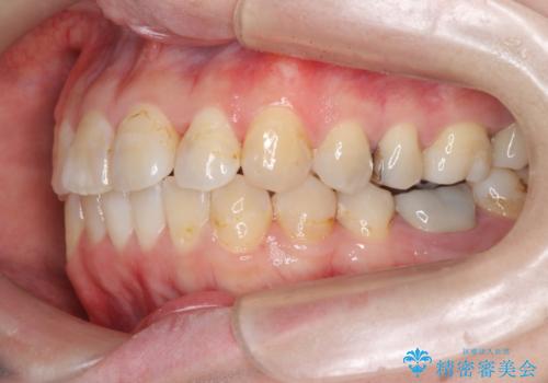 歯のガタガタをマウスピース矯正で治療の治療後