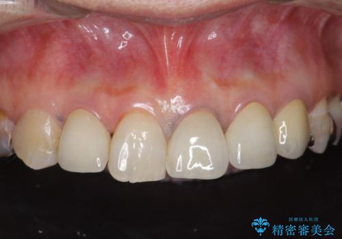 劣化した前歯の差し歯　オールセラミッククラウン審美治療の症例 治療後