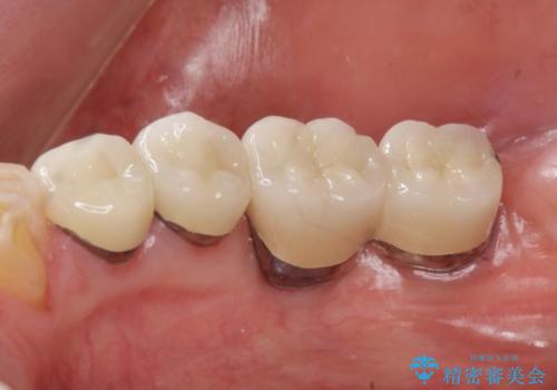 奥歯の喪失  骨造成を伴うインプラント咬合回復の治療後