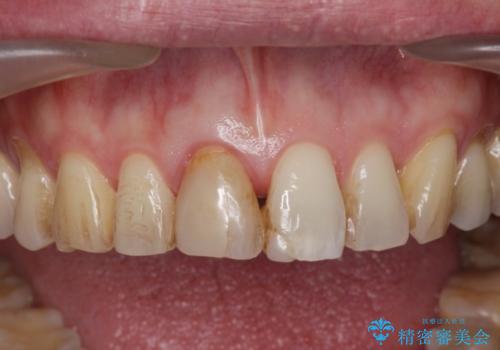 神経の死んだ前歯のレジン修復の劣化　ジルコニアクラウンによる審美回復の治療前