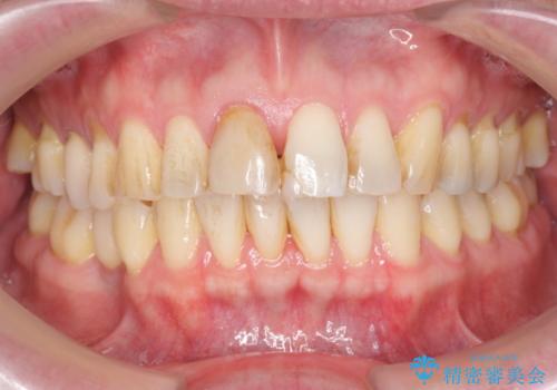 神経の死んだ前歯のレジン修復の劣化　ジルコニアクラウンによる審美回復の治療前