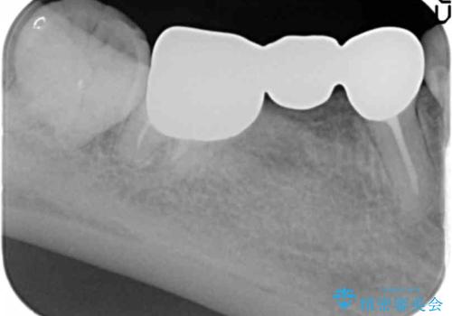 奥歯のブリッジを白く　矯正含めた総合治療で、歯周病、根の問題、一気に解決の治療前
