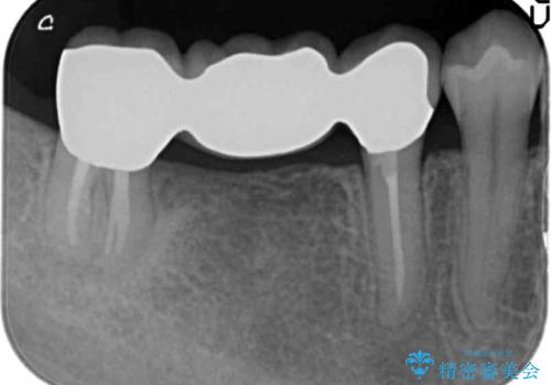 奥歯のブリッジを白く　矯正含めた総合治療で、歯周病、根の問題、一気に解決の治療後
