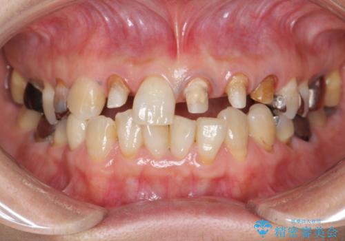 劣化した前歯の差し歯　オールセラミッククラウン審美治療の治療中