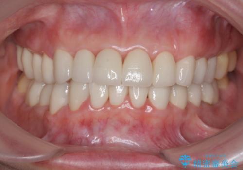 [酸蝕歯] オールセラミックジルコニアクラウン治療の治療後