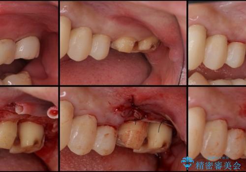 歯肉の中の深い虫歯　外科処置による適正な虫歯治療の治療中