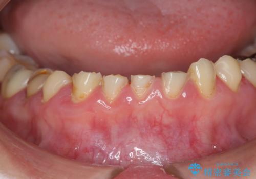 [酸蝕歯] オールセラミックジルコニアクラウン治療の治療前
