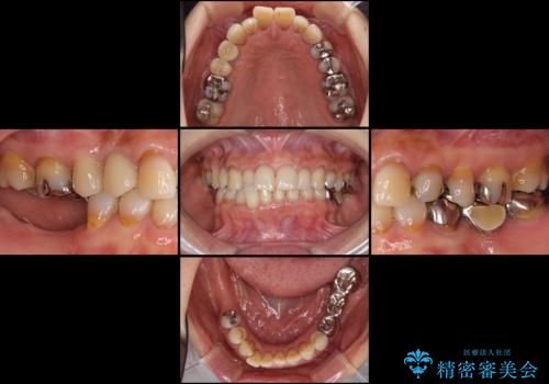 奥歯で咬めない　インプラントによる咬合回復①　骨造成　の治療前