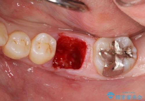 破折による欠損歯　ストローマン社製インプラントによる咬合回復の治療前