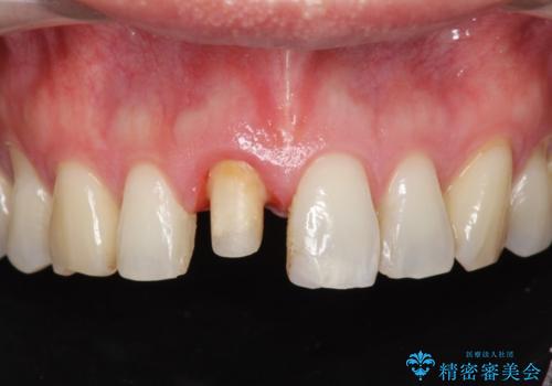 神経の死んだ前歯のレジン修復の劣化　ジルコニアクラウンによる審美回復の治療中