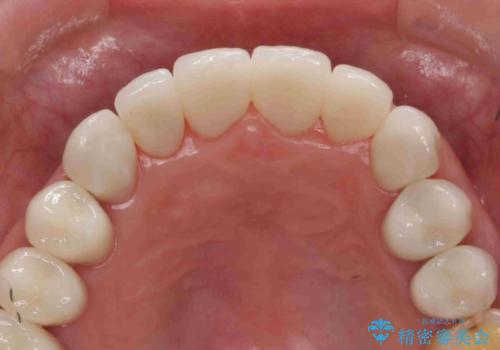 [酸蝕歯] オールセラミックジルコニアクラウン治療の治療後
